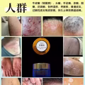 土方皮癣膏牛皮癣药膏土方脚气药膏湿疹寻麻疹皮炎过敏毛囊炎止痒脚气脱皮糜烂脚臭酸臭 图片 1