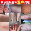 土方皮癣膏牛皮癣药膏土方脚气药膏湿疹寻麻疹皮炎过敏毛囊炎止痒脚气脱皮糜烂脚臭酸臭 图片 14
