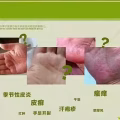 土方皮癣膏牛皮癣药膏土方脚气药膏湿疹寻麻疹皮炎过敏毛囊炎止痒脚气脱皮糜烂脚臭酸臭 图片 21