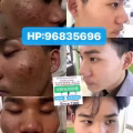 中药专业祛斑祛痘修护去痘印痘坑 图片 13