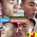 中药专业祛斑祛痘修护去痘印痘坑 图片 28