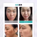 中药专业祛斑祛痘修护去痘印痘坑 图片 29