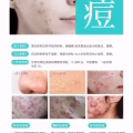 中药专业祛斑祛痘修护去痘印痘坑 图片 40
