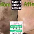 中药专业祛斑祛痘修护去痘印痘坑 图片 27