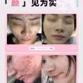 中药专业祛斑祛痘修护去痘印痘坑 图片 42