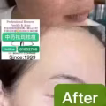 Facial中药专业祛斑痘去黄修护色素管理解决各问题性肌肤HP:81981606 图片 9