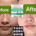 Facial中药专业祛斑痘去黄修护色素管理解决各问题性肌肤HP:81981606 图片 6