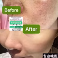 Facial中药专业祛斑痘去黄修护色素管理解决各问题性肌肤HP:81981606 图片 5