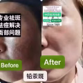 Facial中药专业祛斑痘去黄修护色素管理解决各问题性肌肤HP:81981606 图片 2