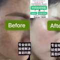 Facial中药专业祛斑痘去黄修护色素管理解决各问题性肌肤HP:81981606 图片 4