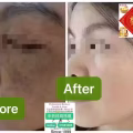 Facial中药专业祛斑痘去黄修护色素管理解决各问题性肌肤HP:81981606 图片 29