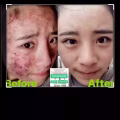 Facial中药专业祛斑痘去黄修护色素管理解决各问题性肌肤HP:81981606 图片 22