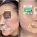 中药专业祛斑祛痘修护去痘印痘坑 图片 4