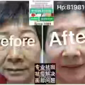 中药专业祛斑祛痘修护去痘印痘坑 图片 8