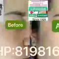 中药专业祛斑祛痘修护去痘印痘坑 图片 10