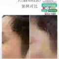 中药专业祛斑祛痘修护去痘印痘坑 图片 18