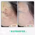 中药专业祛斑祛痘修护去痘印痘坑 图片 21