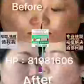 中药专业祛斑祛痘修护去痘印痘坑 图片 22