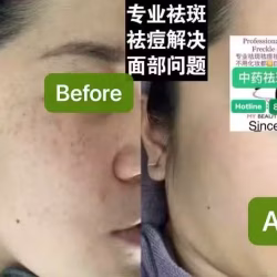 Facial中药专业祛斑痘去黄修护色素管理解决各问题性肌肤HP:81981606