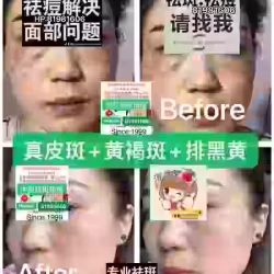 中药专业祛斑祛痘修护去痘印痘坑