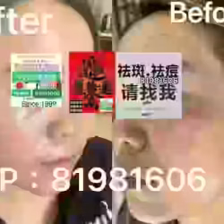 中药专业祛斑祛痘修护去痘印痘坑