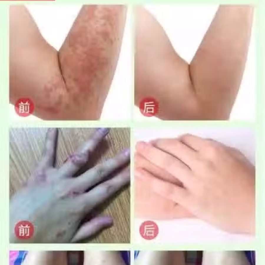 一抹灵/祛“湿”好货（现货）不含激素 图片 8
