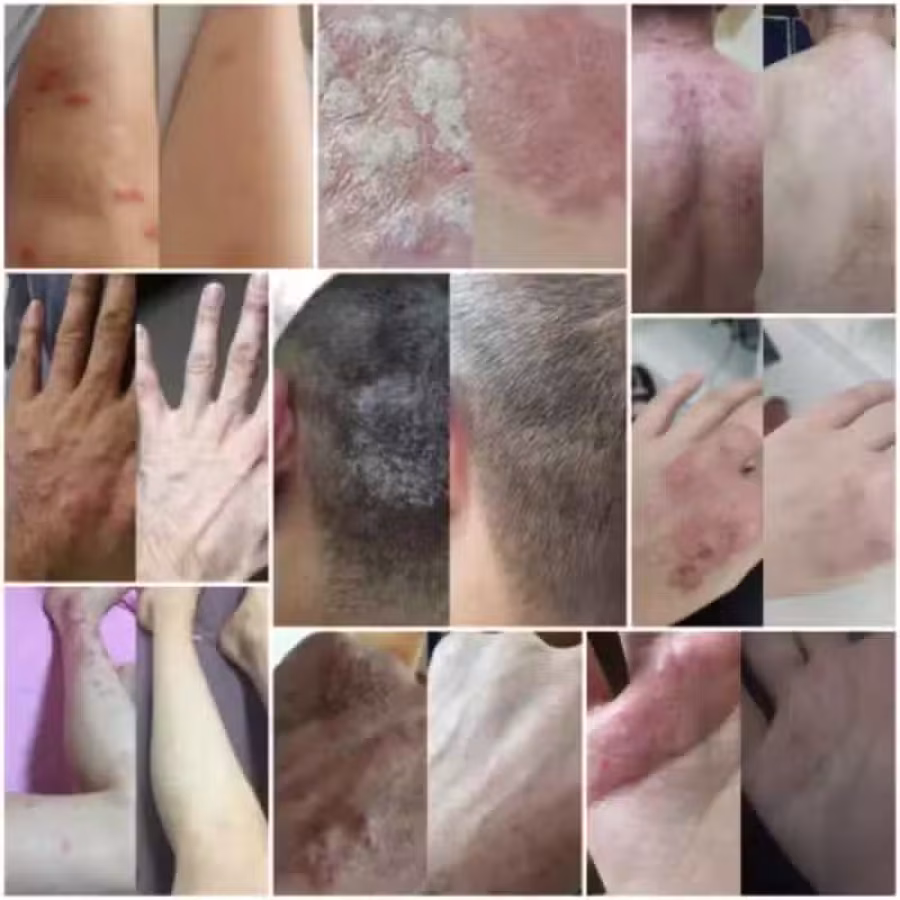 土方皮癣膏牛皮癣药膏土方脚气药膏湿疹寻麻疹皮炎过敏毛囊炎止痒脚气脱皮糜烂脚臭酸臭 图片 3