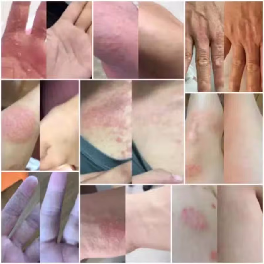 土方皮癣膏牛皮癣药膏土方脚气药膏湿疹寻麻疹皮炎过敏毛囊炎止痒脚气脱皮糜烂脚臭酸臭 图片 5