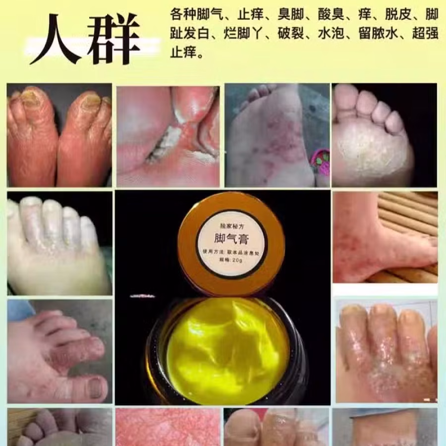 土方皮癣膏牛皮癣药膏土方脚气药膏湿疹寻麻疹皮炎过敏毛囊炎止痒脚气脱皮糜烂脚臭酸臭 图片 9