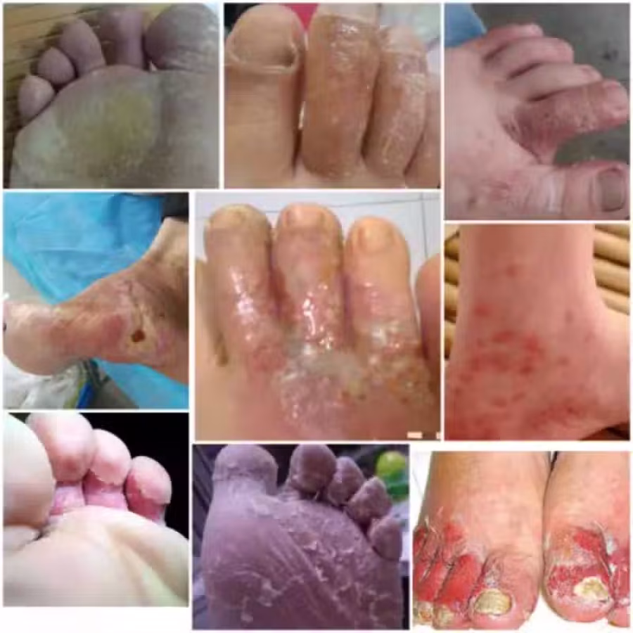 土方皮癣膏牛皮癣药膏土方脚气药膏湿疹寻麻疹皮炎过敏毛囊炎止痒脚气脱皮糜烂脚臭酸臭 图片 10