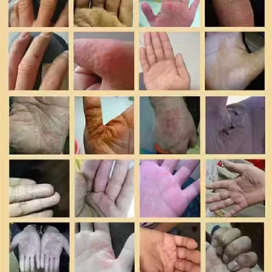 土方皮癣膏牛皮癣药膏土方脚气药膏湿疹寻麻疹皮炎过敏毛囊炎止痒脚气脱皮糜烂脚臭酸臭 图片 16