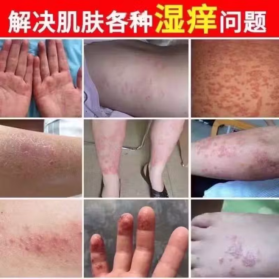 土方皮癣膏牛皮癣药膏土方脚气药膏湿疹寻麻疹皮炎过敏毛囊炎止痒脚气脱皮糜烂脚臭酸臭 图片 14