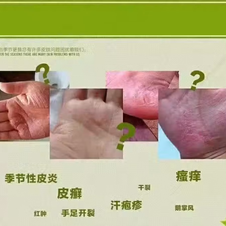 土方皮癣膏牛皮癣药膏土方脚气药膏湿疹寻麻疹皮炎过敏毛囊炎止痒脚气脱皮糜烂脚臭酸臭 图片 21