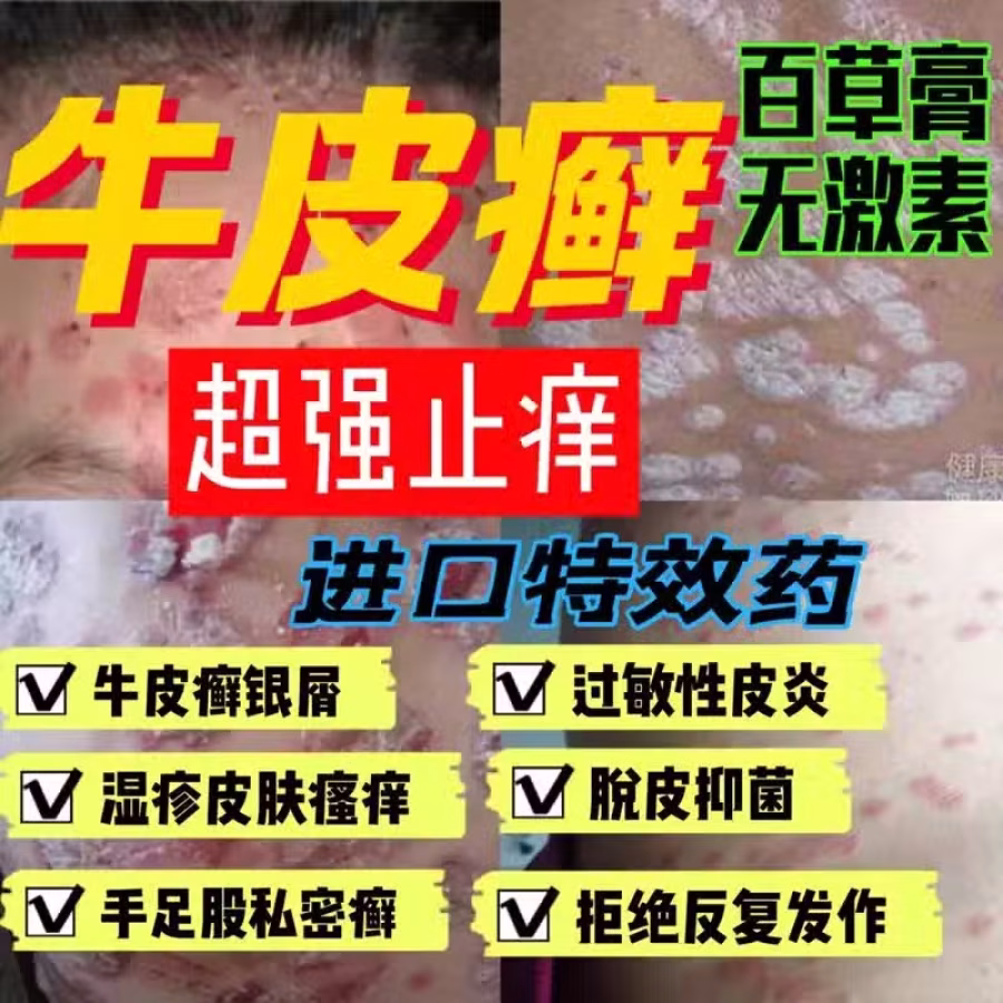 土方皮癣膏牛皮癣药膏土方脚气药膏湿疹寻麻疹皮炎过敏毛囊炎止痒脚气脱皮糜烂脚臭酸臭 图片 19