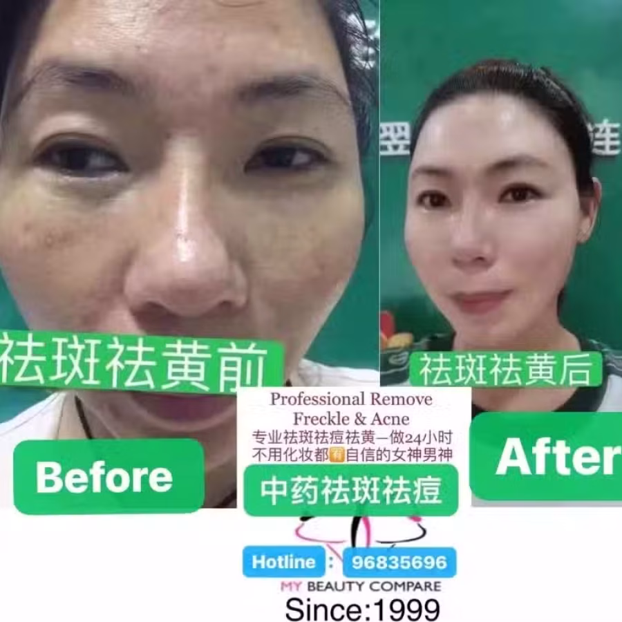 中药专业祛斑祛痘修护去痘印痘坑 图片 45