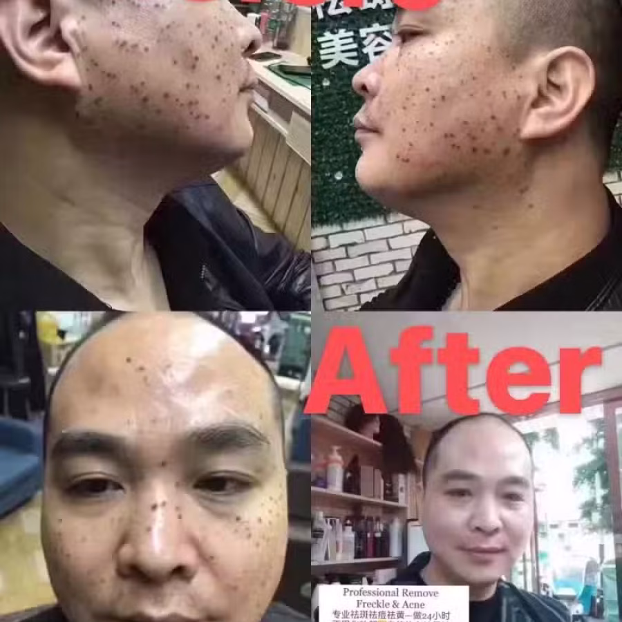 中药专业祛斑祛痘修护去痘印痘坑 图片 19