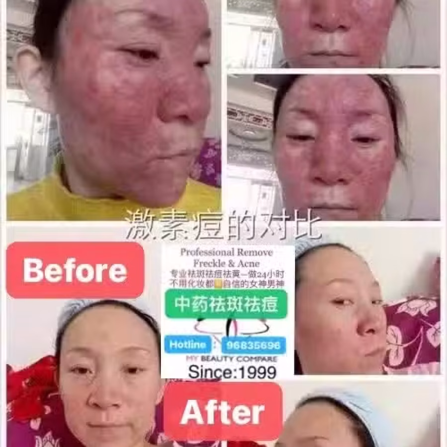 中药专业祛斑祛痘修护去痘印痘坑 图片 26