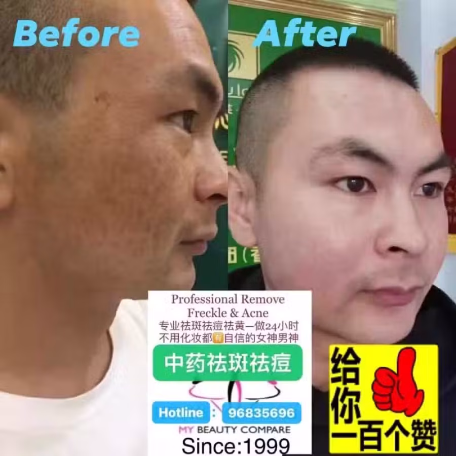 中药专业祛斑祛痘修护去痘印痘坑 图片 33