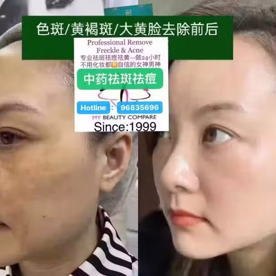 中药专业祛斑祛痘修护去痘印痘坑 图片 36