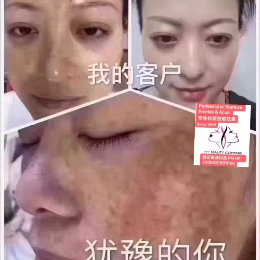 中药专业祛斑祛痘修护去痘印痘坑 图片 43