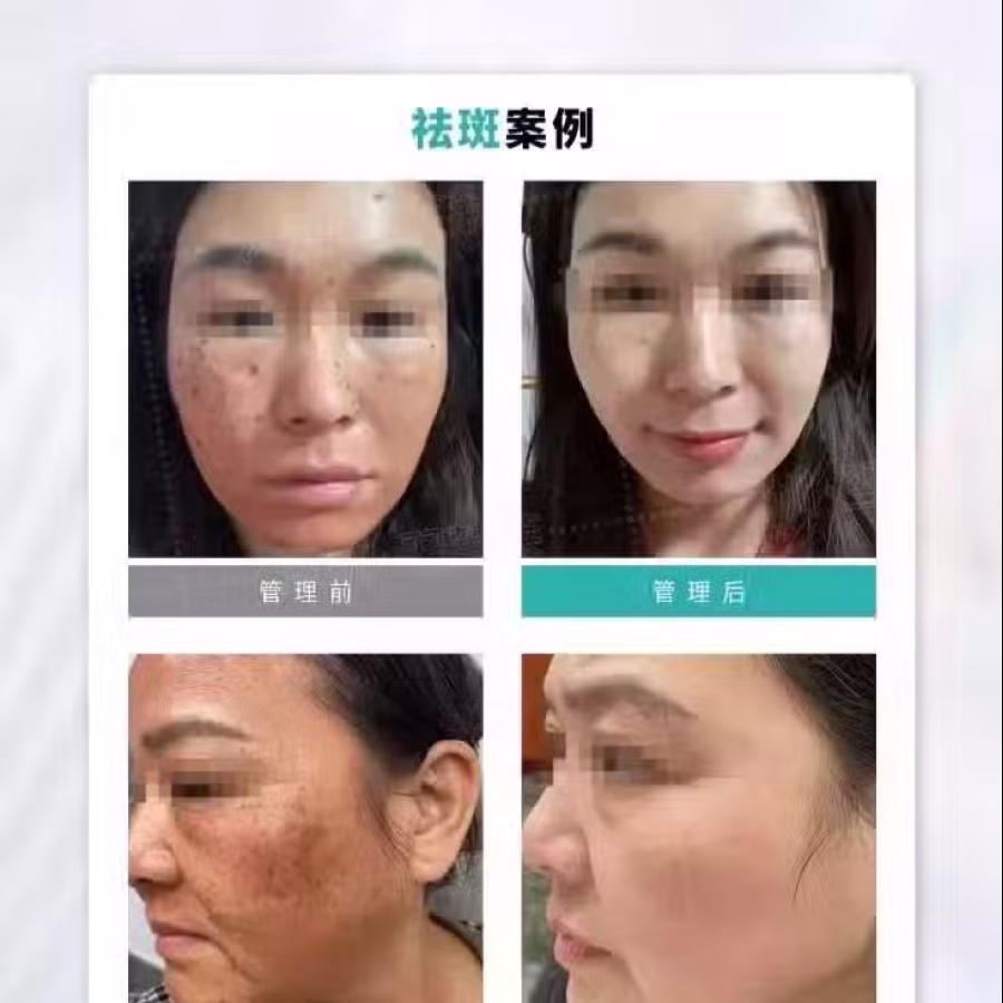 中药专业祛斑祛痘修护去痘印痘坑 图片 29
