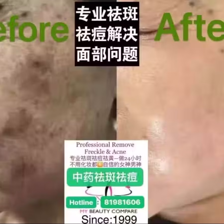 中药专业祛斑祛痘修护去痘印痘坑 图片 27