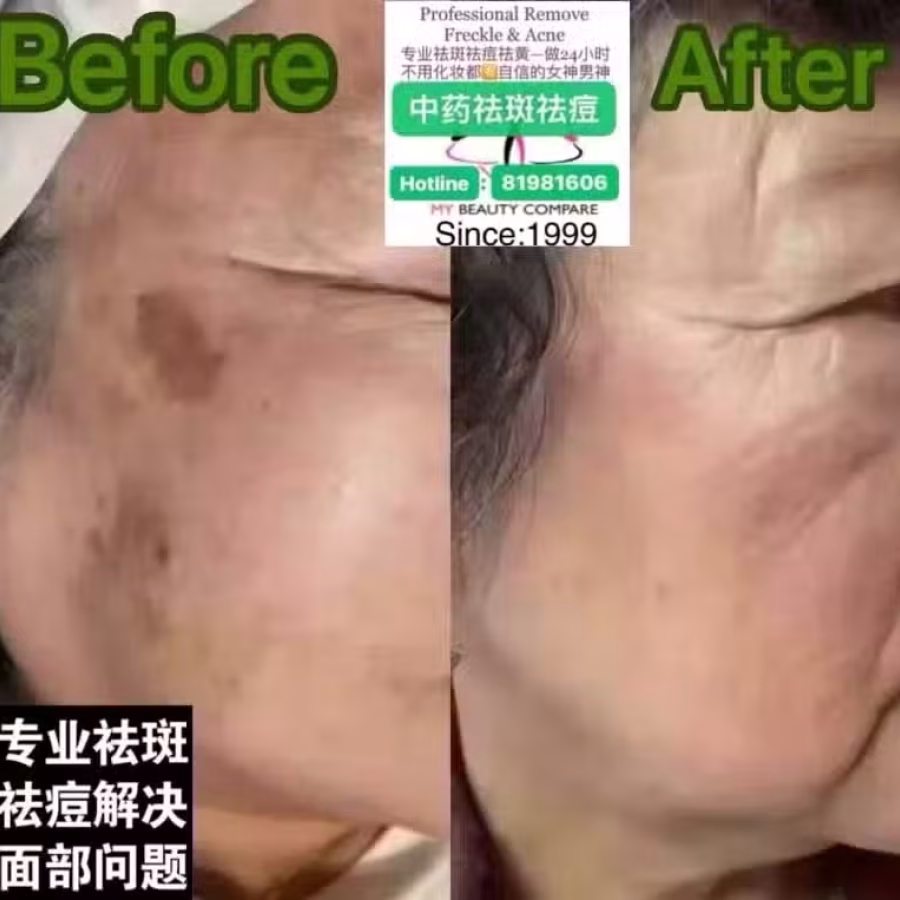 中药专业祛斑祛痘修护去痘印痘坑 图片 23