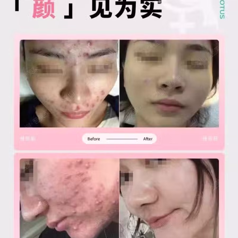 中药专业祛斑祛痘修护去痘印痘坑 图片 42