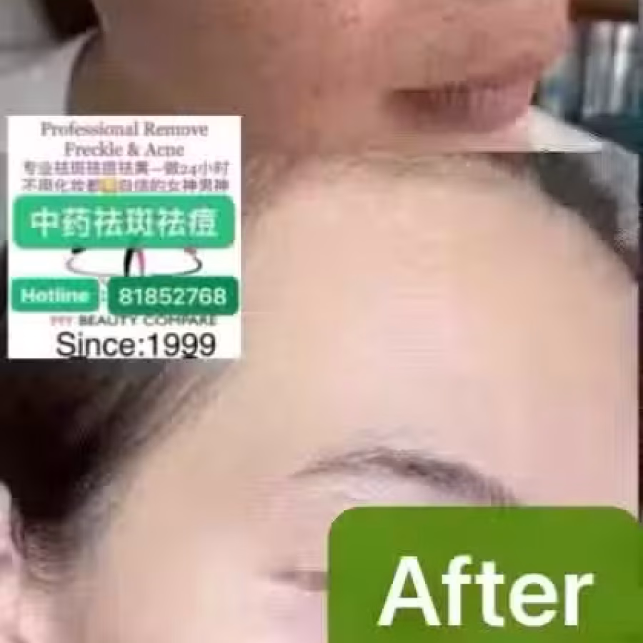 Facial中药专业祛斑痘去黄修护色素管理解决各问题性肌肤HP:81981606 图片 9