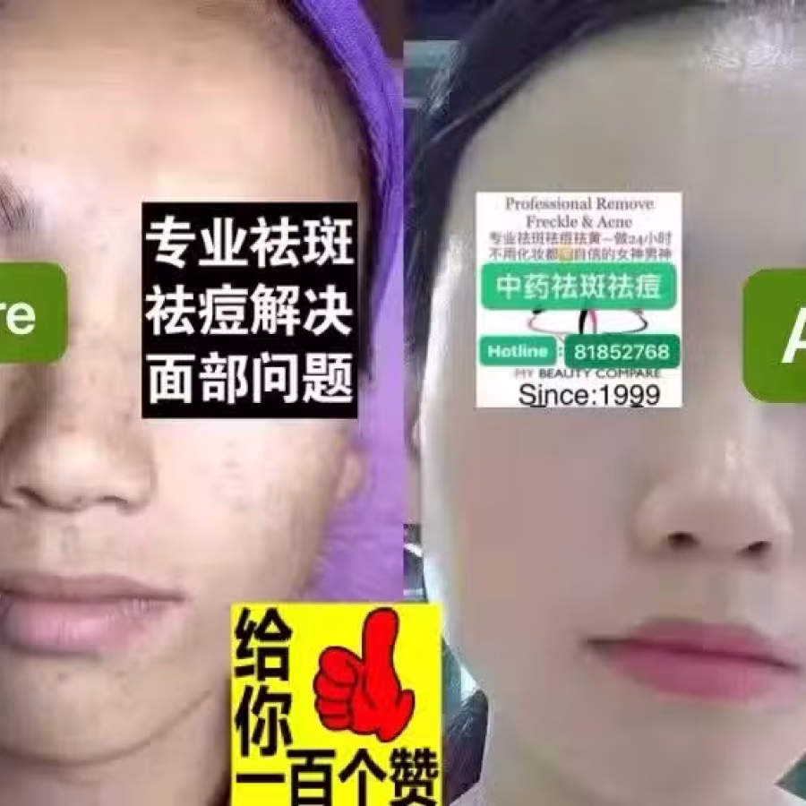 Facial中药专业祛斑痘去黄修护色素管理解决各问题性肌肤HP:81981606 图片 7