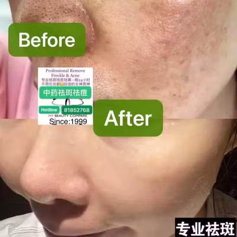 Facial中药专业祛斑痘去黄修护色素管理解决各问题性肌肤HP:81981606 图片 5