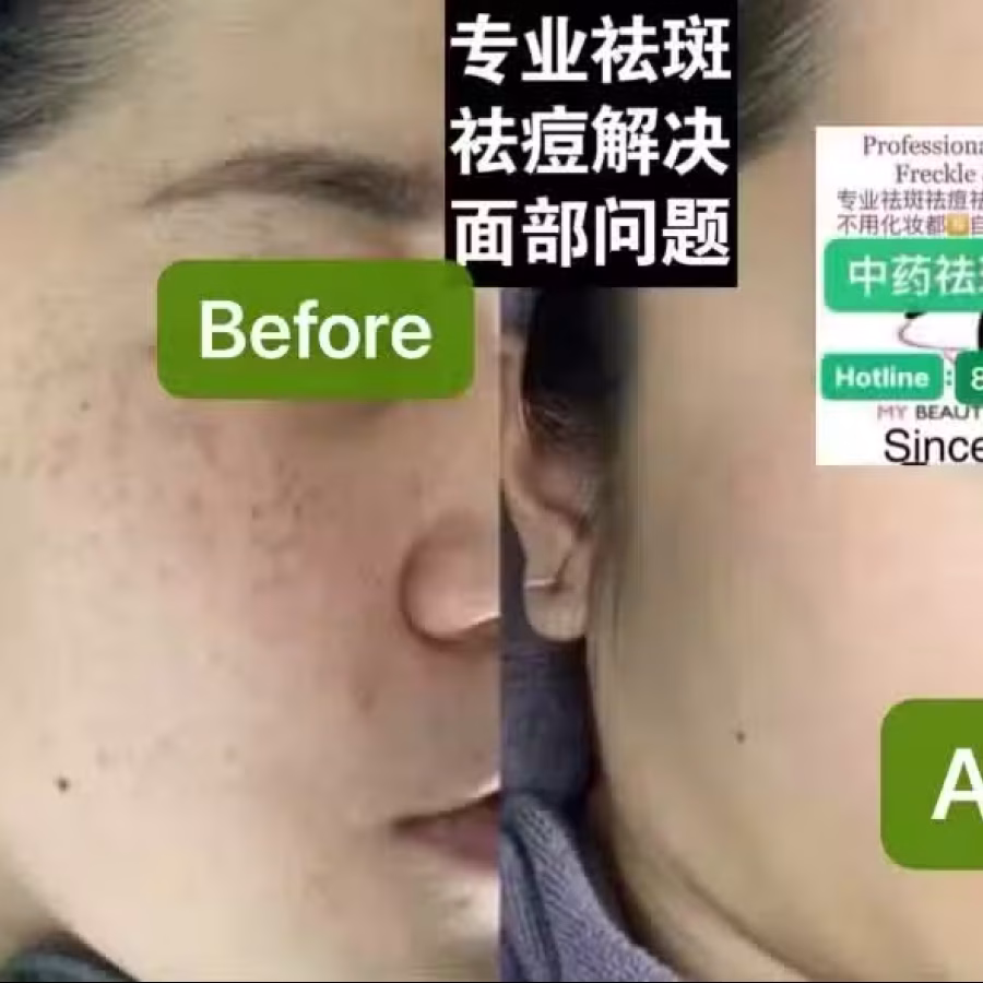 Facial中药专业祛斑痘去黄修护色素管理解决各问题性肌肤HP:81981606 图片 1