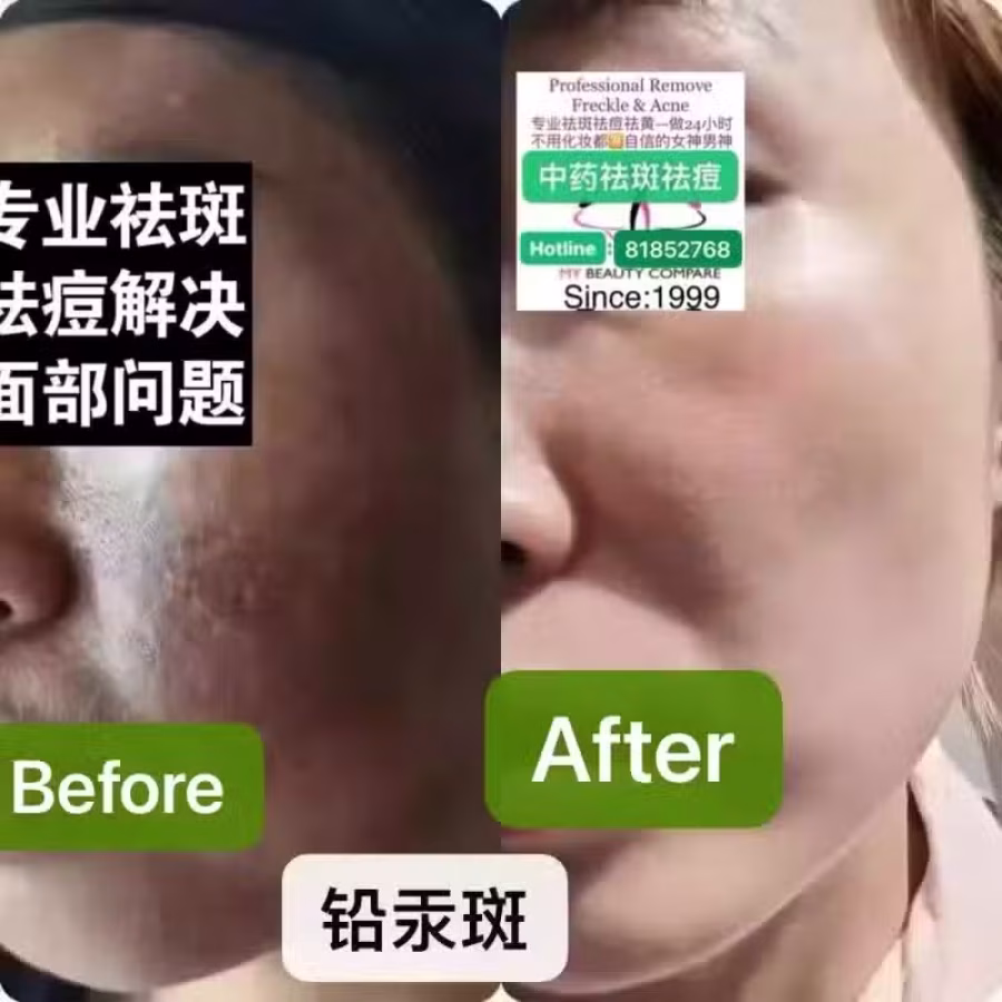 Facial中药专业祛斑痘去黄修护色素管理解决各问题性肌肤HP:81981606 图片 2