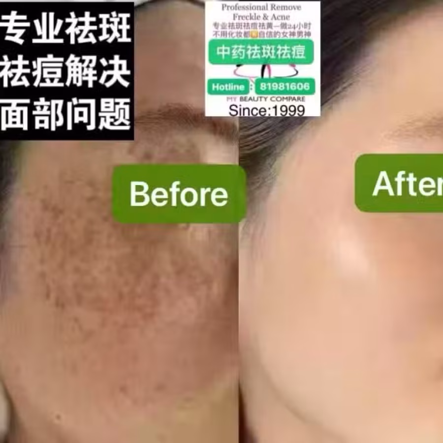 Facial中药专业祛斑痘去黄修护色素管理解决各问题性肌肤HP:81981606 图片 10